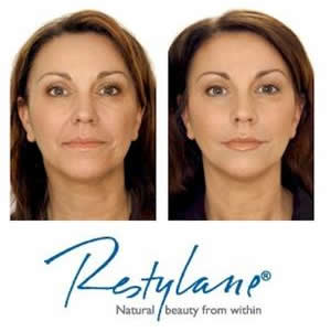 nasoloabial smile line fillers botox long island